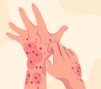 Eczema or Psoriasis? Spot the Difference