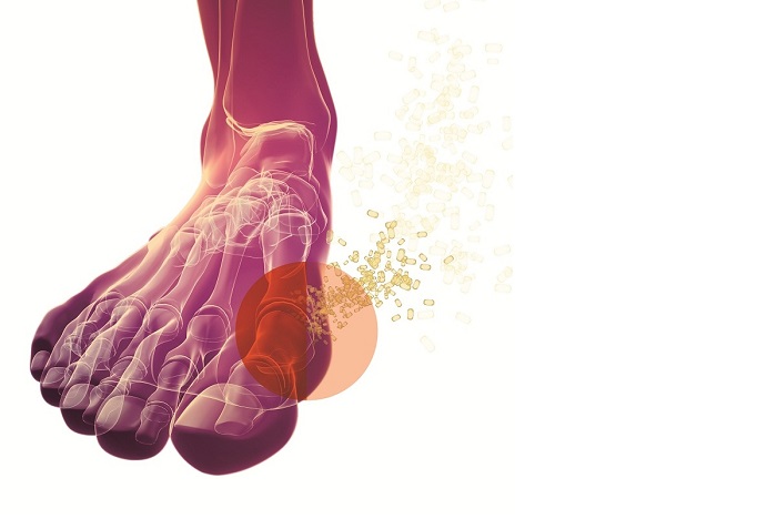 Pdf Acute Gout In Hospitalized Patients In Sarawak General Hospital Semantic Scholar